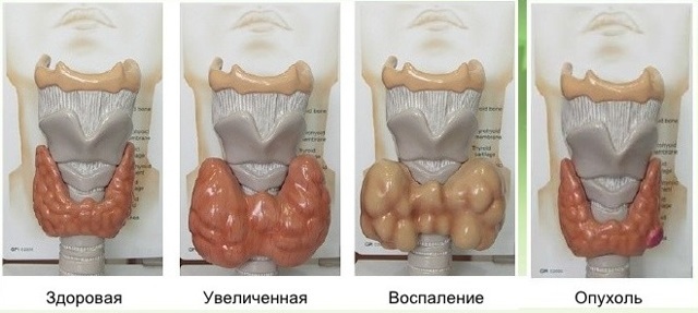 УЗИ щитовидной железы