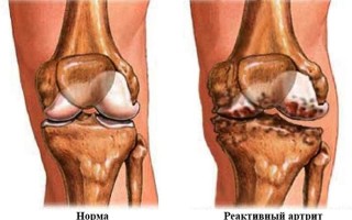 Воспаление сустава (артрит) Воспаление сустава (артрит)