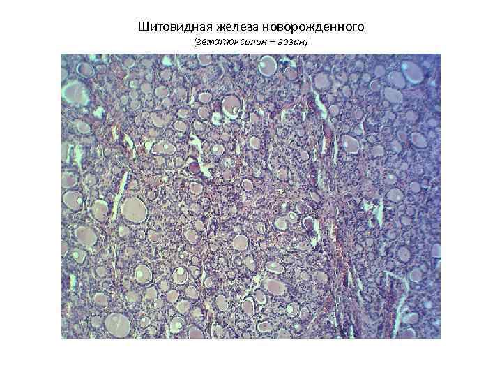 Ткань щитовидной железы у новорожденного (микроскоп) Ткань щитовидной железы у новорожденного (микроскоп)