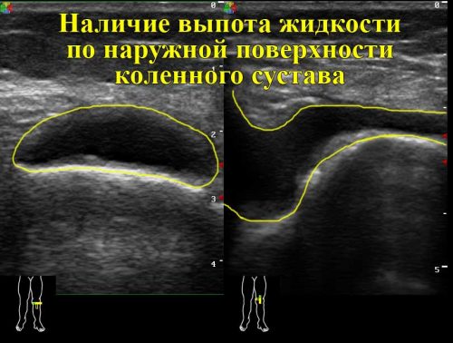 Бурсит (жидкость в полости сустава)