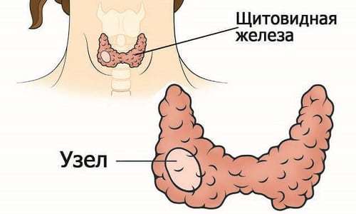 Узел в ткани железы Узел в ткани железы
