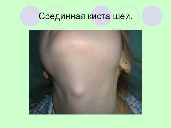 Врожденная срединная киста шеи Врожденная срединная киста шеи