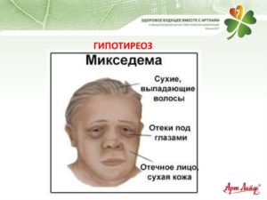 Гипотиреоз Гипотиреоз