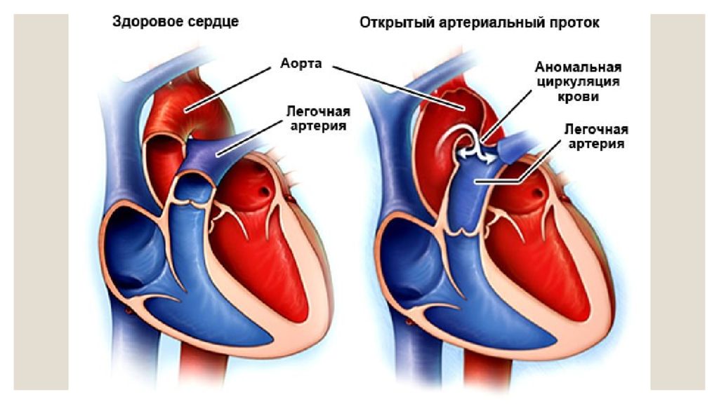 Схема открытого артериального протока