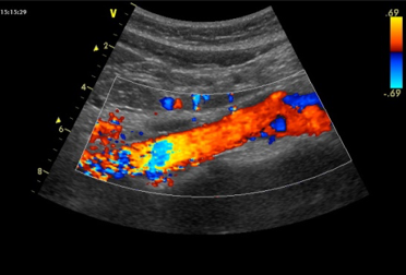 Узи с цдк брюшная. Ультразвуковое дуплексное ангиосканирование.  Дуплексное и триплексное сканирование сосудов. Ультразвуковая допплерография аорты. Уз допплерография в дуплексном режиме парных сосудов артерий и вен.