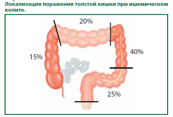 Поверхностный колит. Локализация поражения толстой кишки. Колит Толстого кишечника. Ишемический колит локализация.